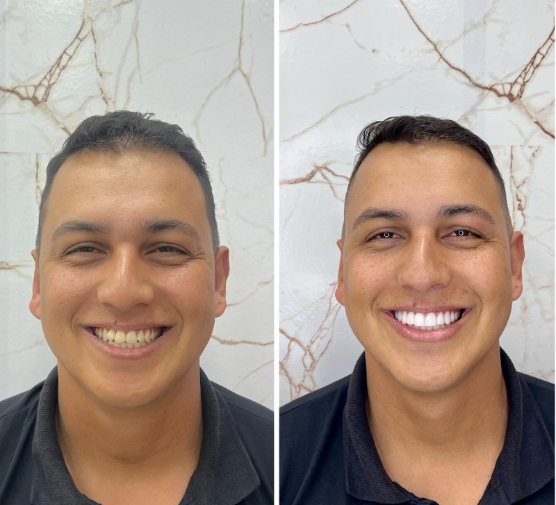 Antes e Depois - Transformação 5